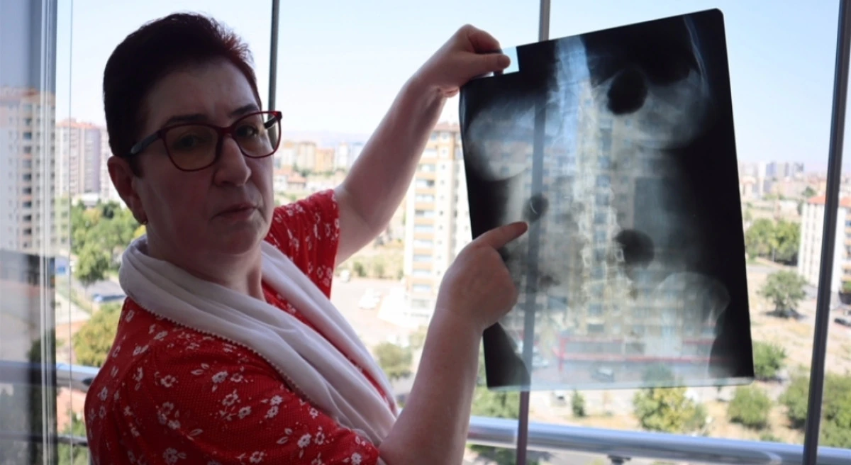 22 yıldır karnında ameliyat iğnesiyle yaşıyor 