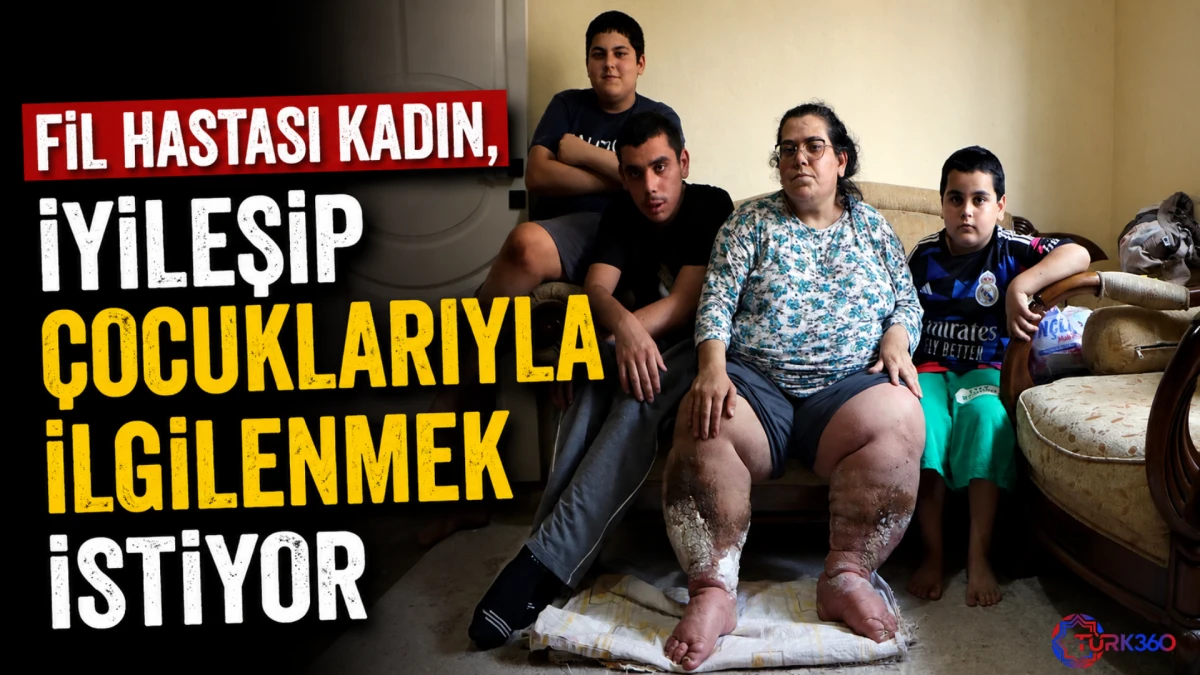 Fil hastası kadın, iyileşip &ccedil;ocuklarıyla ilgilenmek istiyor 