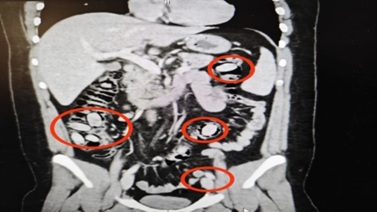 Kuryenin Akılalmaz Y&ouml;ntemi! Yurt Dışından Getirdi, Midesinde Sakladı; Ameliyatla &Ccedil;ıkarıldı!